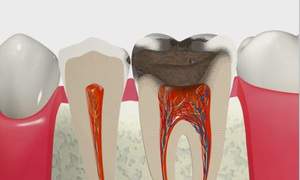C3の虫歯が神経まで進んでいる歯の断面図