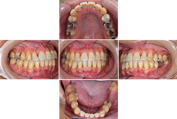 インプラント手術1ヶ月