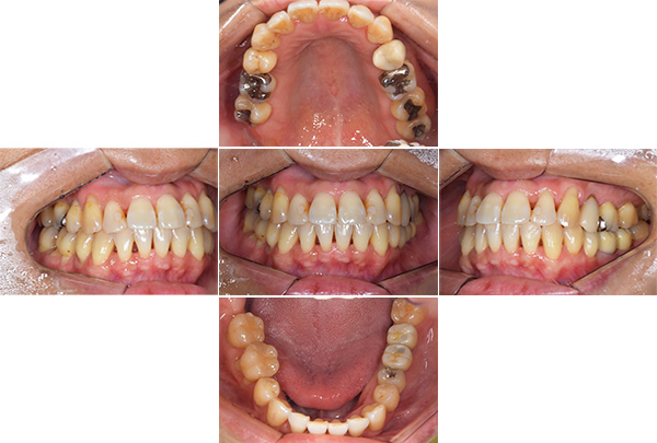 インプラント手術後