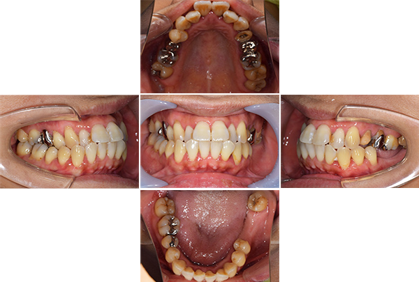 インプラント手術前