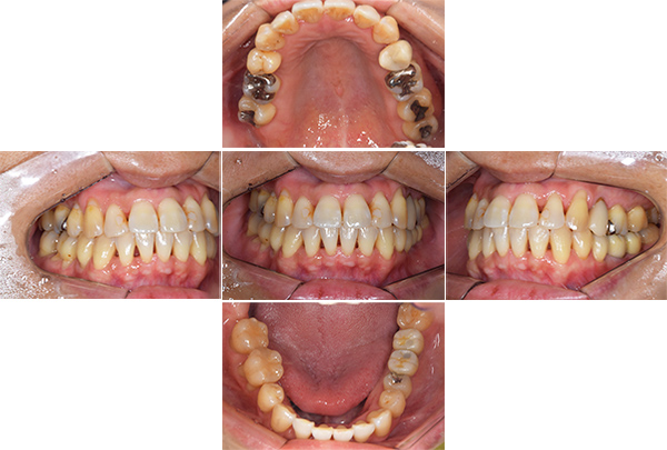 インプラント手術後