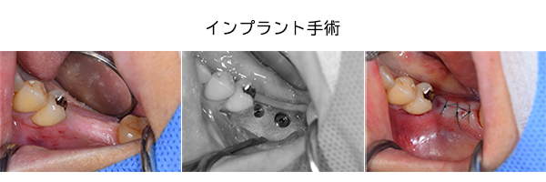 インプラント手術