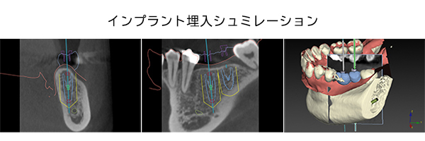 インプラント埋入シミュレーション