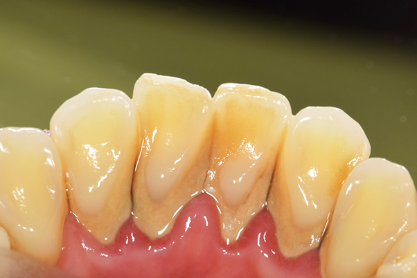 前歯舌側の歯石