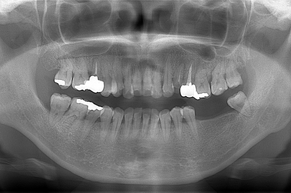 初診時レントゲン写真