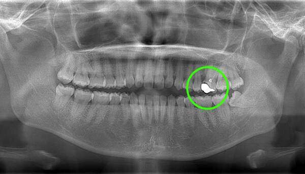 麻布十番歯科で虫歯の親知らずのレントゲン画像のイメージ