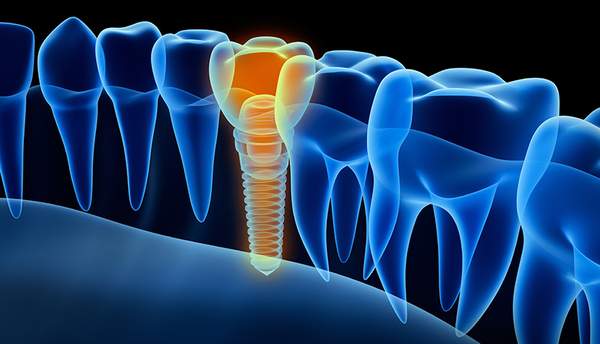 インプラント治療を行った箇所がオレンジ色、それ以外の歯が青色で色分けがされている画像