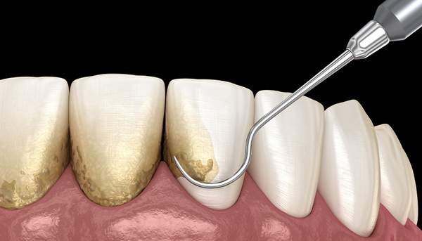 歯の汚れを歯科用器具で取り除いているイメージ