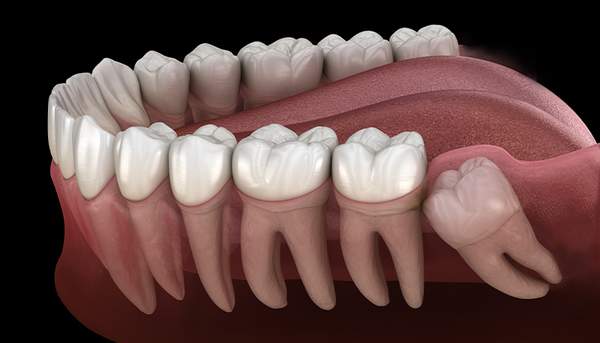 埋伏抜歯(親知らずなど)