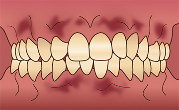 歯ぐきの色を綺麗にしたい