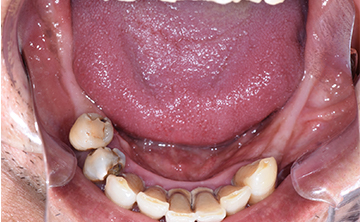 麻布十番歯科で虫歯を3年放置した方の下顎の症例写真