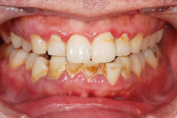 治療前：初期〜中等度歯周病治療