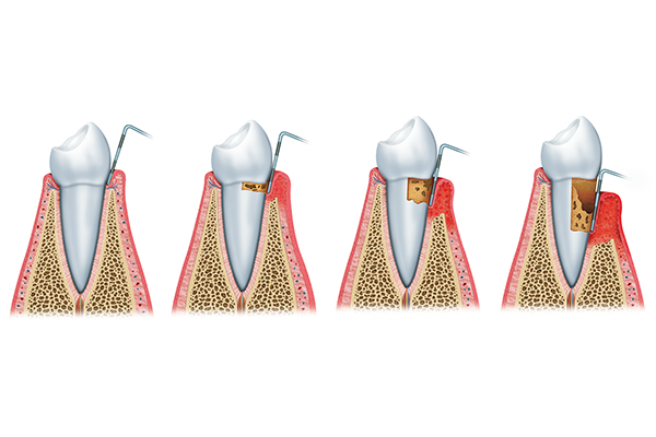 歯周病精密検査中の歯のイラスト