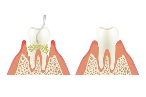 深部歯石の除去のイラスト