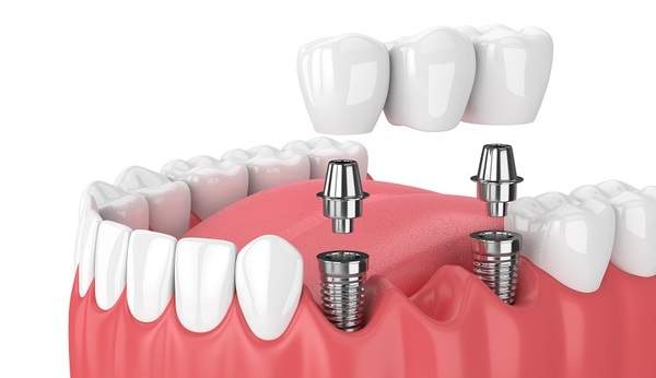インプラント治療