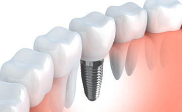 治療方法3:インプラント