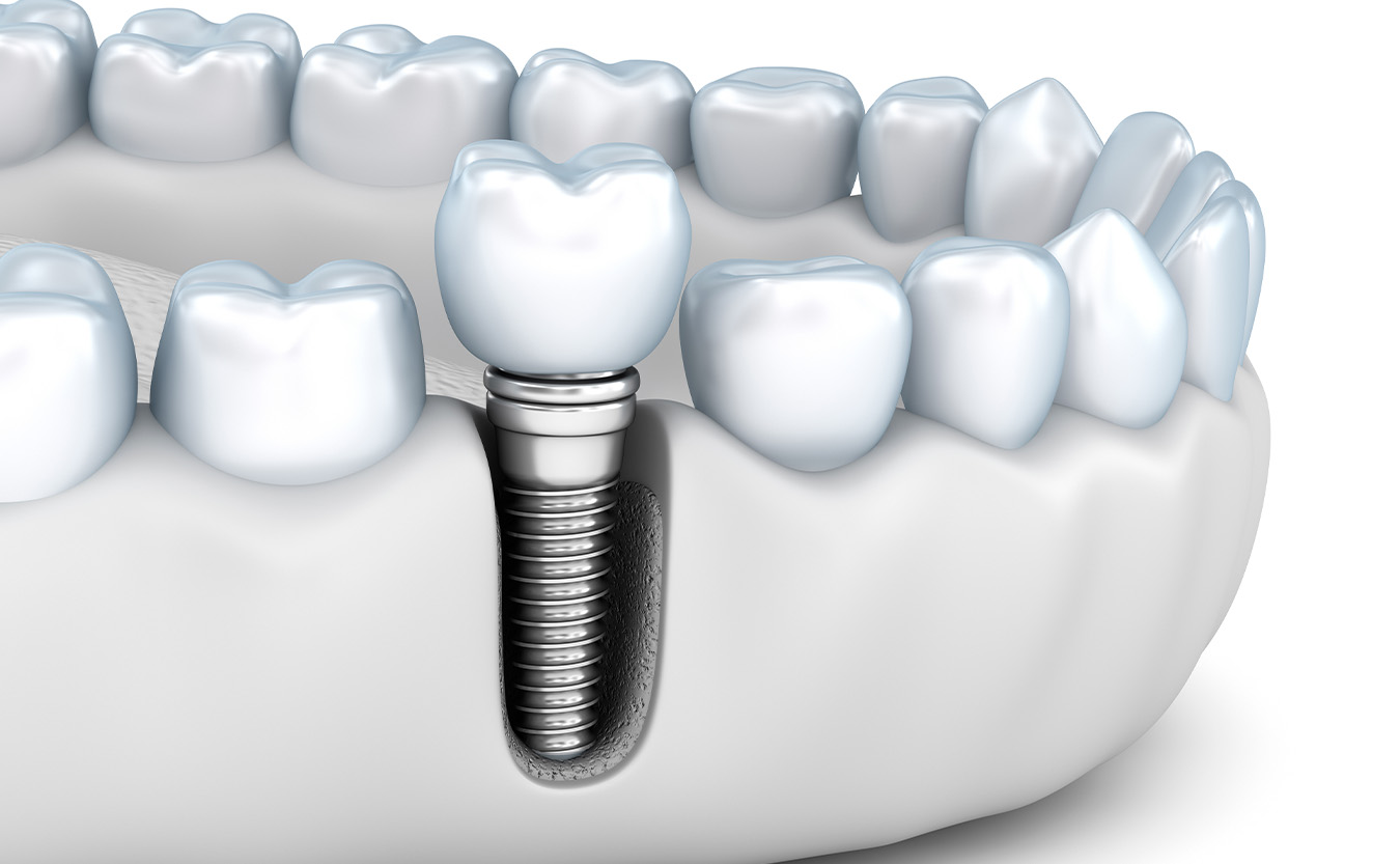 麻布十番の歯医者のインプラント治療のソケットプリザベーションのイメージ