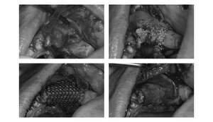 ソケットリフト