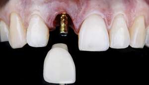 インプラント治療の前処置