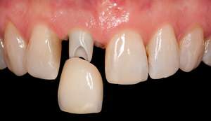 インプラント手術