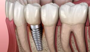 インプラント周囲粘膜炎