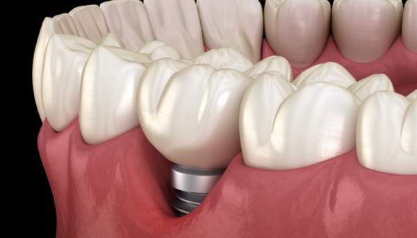 歯肉移植について