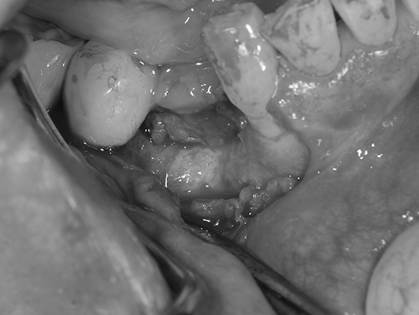 麻布十番歯科のインプラント手術の症例①