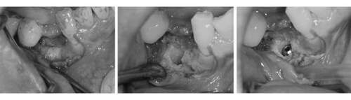 麻布十番歯科のインプラント手術の症例