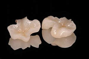 セラミックインレー