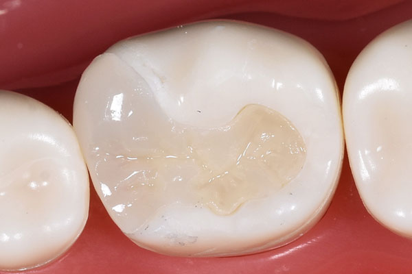 セラミックインレー