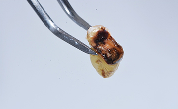 最重度（C4）の虫歯で抜歯後の歯の写真