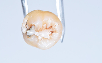 虫歯になってしまった抜歯後の歯の写真