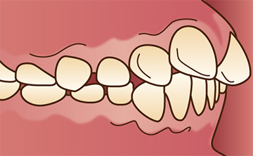 歯並びが悪い