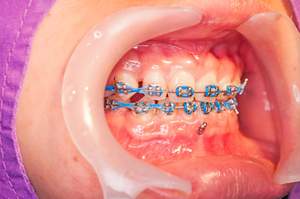 ワイヤー矯正中の前歯