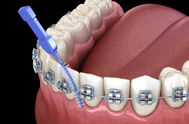 ワイヤー矯正中の歯のお手入れとして歯間ブラシを使用しているイメージ