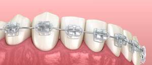 ワイヤー矯正で使用する矯正装置を装着した歯のイメージ