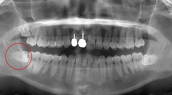 麻布十番歯科で親知らずが横向きに生えている症例のレントゲン写真のイメージ
