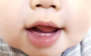 お子さまの虫歯予防