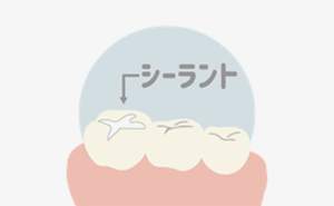 シーラントとは