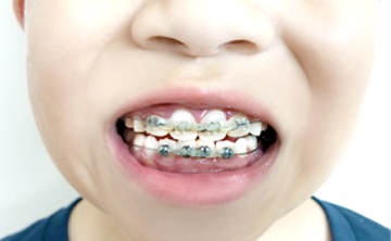 小児の矯正治療