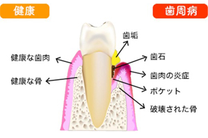 歯周病と健康な状態の歯と歯ぐきのイラスト