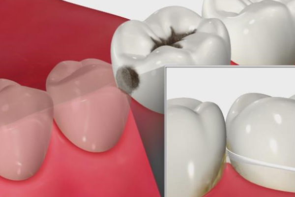 虫歯になりやすい隣接面にフロスを通しているイラスト