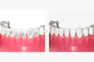 PMTC施術前後の歯の着色の変化のイラスト