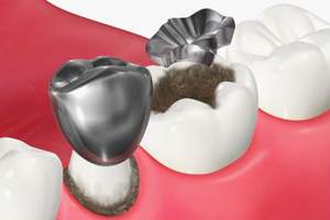 詰め物・被せ物による二次カリエス