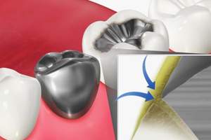 歯と詰め物の隙間に汚れが溜まっているイラスト