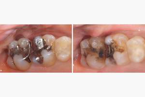 麻布十番歯科で銀歯が虫歯になってしまった症例の口腔内写真