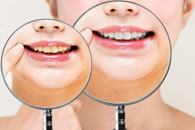 麻布十番の歯医者さんで専門の器具を使用して歯の汚れを落とすと着色汚れも綺麗にできるイメージ