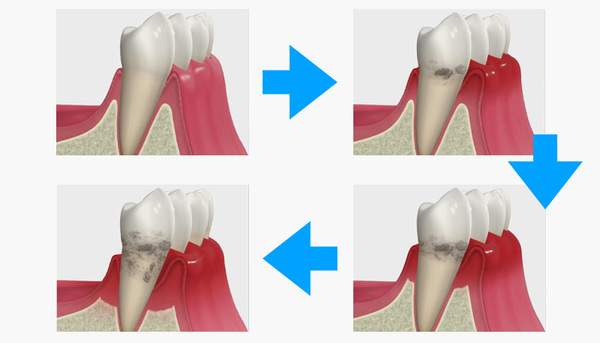 歯周病で歯槽骨が溶けていく経過のイラスト