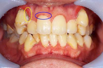歯周病症例の治療前