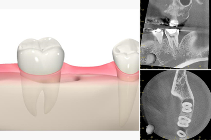 再生治療で使用する薬を患部で維持で効果がないでやすい場合の歯と歯ぐきのイメージ